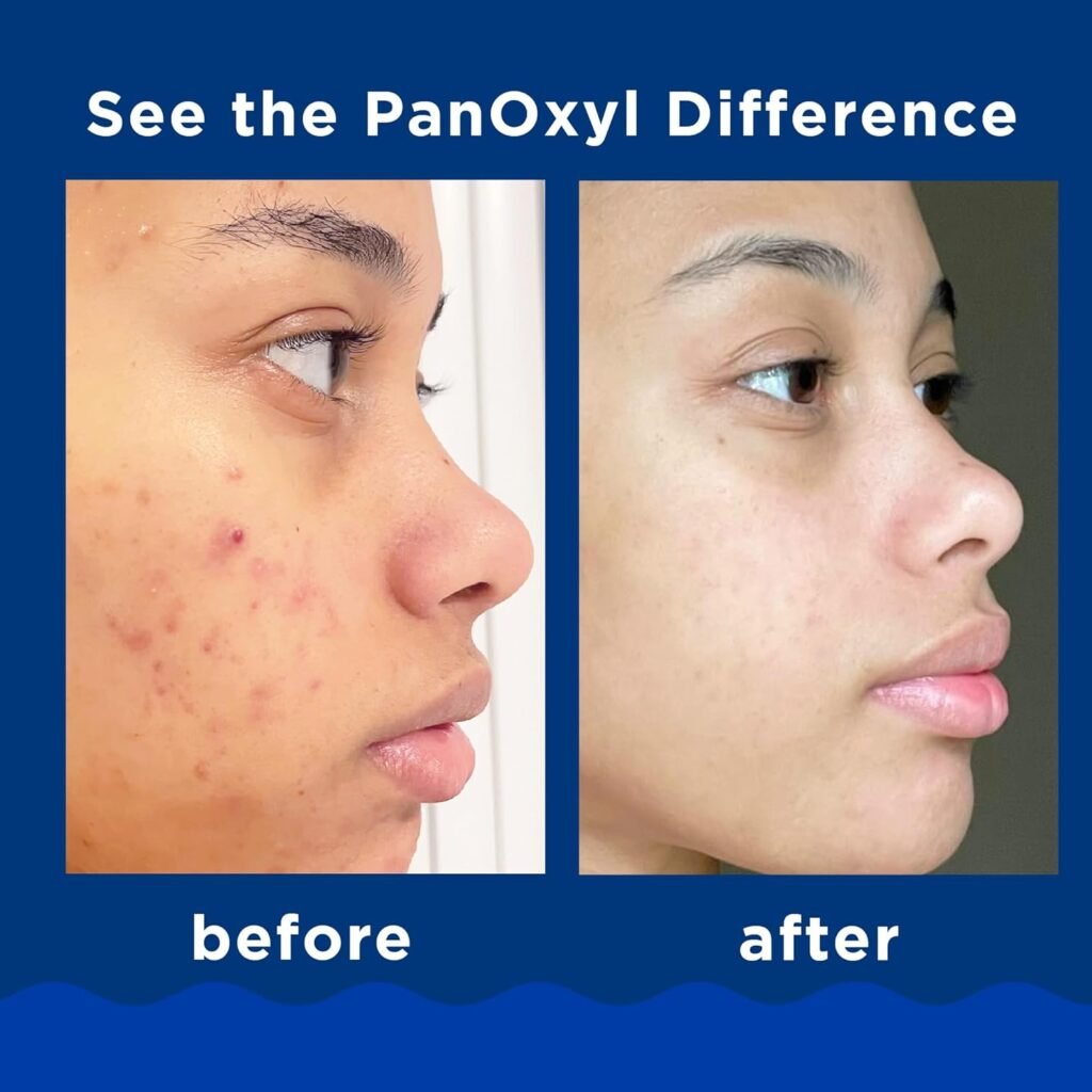 PanOxyl Acne Foaming Wash 10% Benzoyl Peroxide 5.5 oz (156 g)